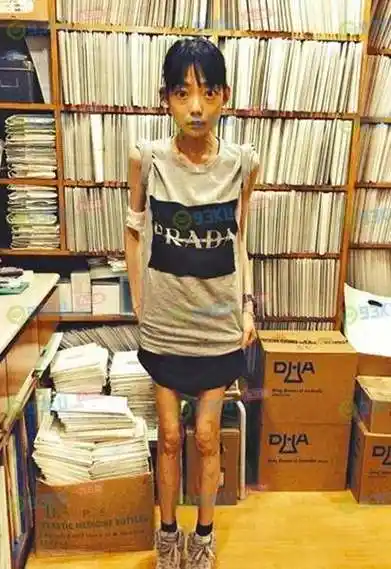 22岁嫁入豪门,患病6年惨遭抛弃,今瘦成皮包骨却不能吃东西!