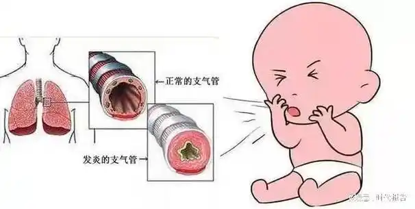 【健康科普】小儿支气管肺炎与小儿支气管炎的区别