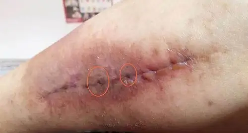 的,毕竟手术的时候那么痛都忍过来了,打止痛针据说还会影响伤口恢复