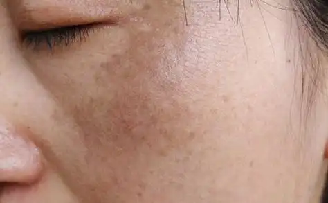 皮肤暗沉喝什么能改善