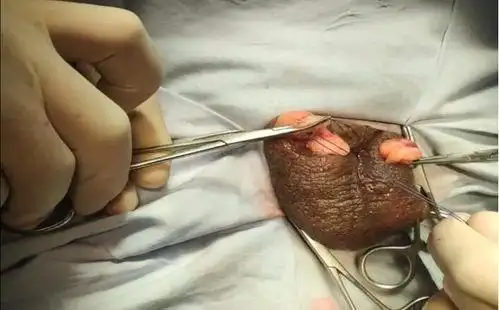 睾丸切除术后注意事项,一侧睾丸切除术后注意事项,双侧睾丸切除术后