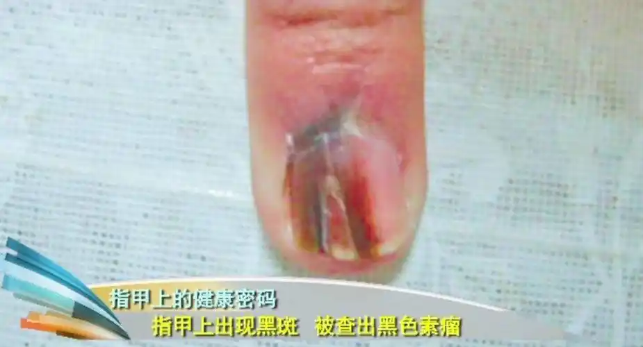 指甲上长了一条线,几年后竟成了恶性肿瘤!