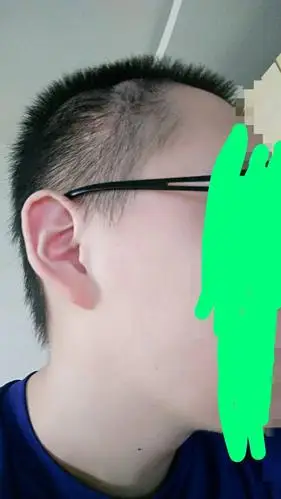 鬓角是否属于脱发