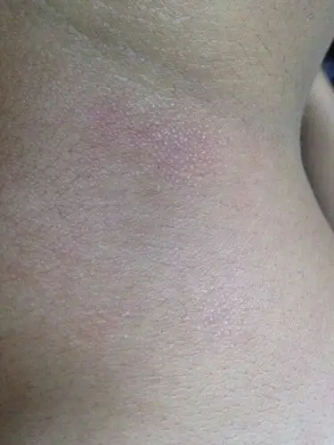 我最近脖子后面出现类似像皮肤癣一样的东西这是什么?