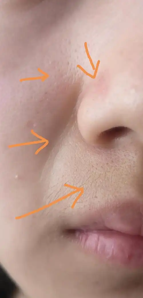 【有图慎入】脸部毛孔问题