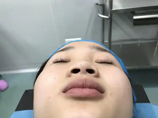 手术缩鼻翼手术缩鼻翼手术缩鼻翼鼻翼缩小