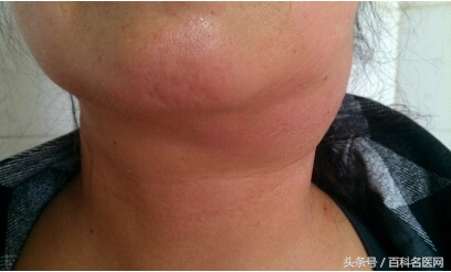 颈部淋巴结肿大症状用手怎么判断是淋巴结