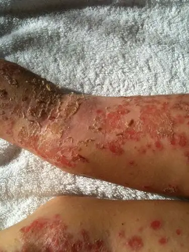 湿疹图片和症状 (21)