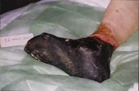 身上皮肤坏死如何治疗?