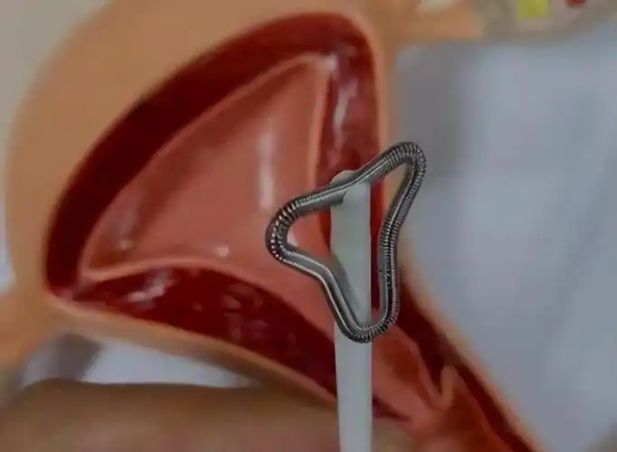 医生提醒:最佳取环年龄别超这一数