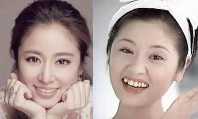 明星们的牙齿怎么都这么好看整牙前后大对比效果堪比整容