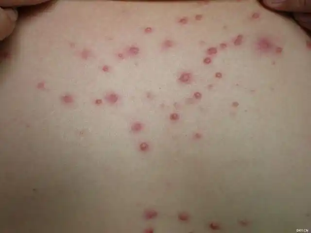 【共享】常见皮肤疾病典型图片 [精华] [病例帖]