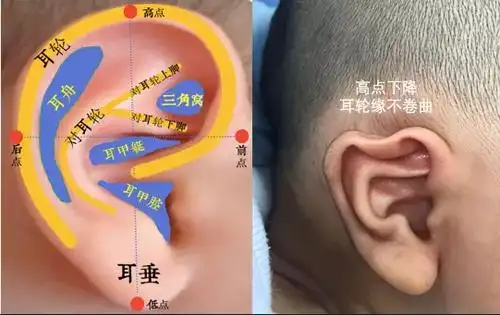 耳轮脚横突耳甲腔畸形隐耳可以在早期通过无创矫正耳畸形,以免长大后