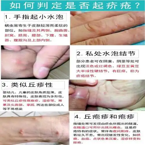 疥疮结节一扫光疥虫阴虱螨虫外用阴囊皮肤瘙痒动物保健品