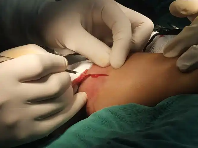 凌楚眠 的想法: 7岁小朋友的上臂深部脓肿切开排脓 - 知乎