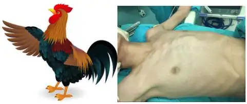 小朋友胸部前凸怎么办啊鸡胸需要手术吗