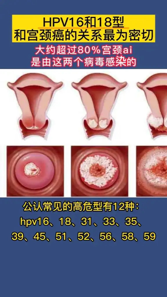 hpv1618阳性和宫颈癌关系最为密切