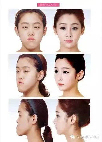 史上最全亮瞎眼的韩国高端整容前后对比图