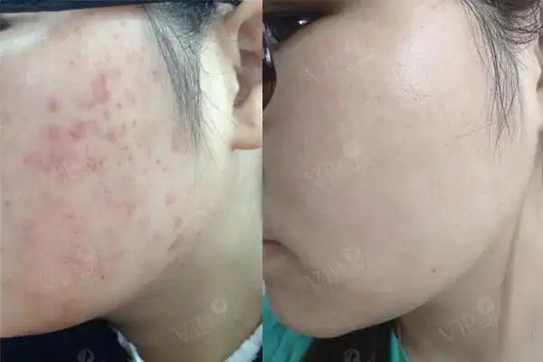 脸颊两边疯狂的长了很多痘痘,有什么好用的祛痘产品?