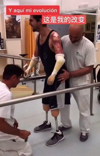 截肢的24岁男孩因为康复治疗他可以活得很好