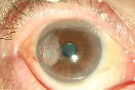 角膜溃疡的症状