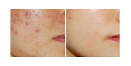 袪痘-红蓝光袪痘效果图,案例前后对比照片