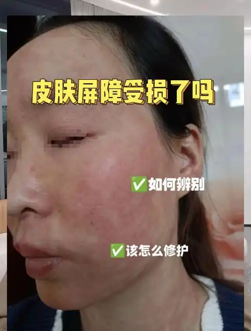 第155集:你的皮肤屏障受损了吗?怎么辨别?该怎么修护?