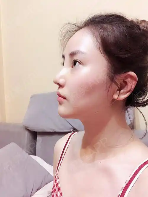 今天是手术后七天,终于拆线啦恢复期真的是漫长的,每.垫鼻尖_悦美整形