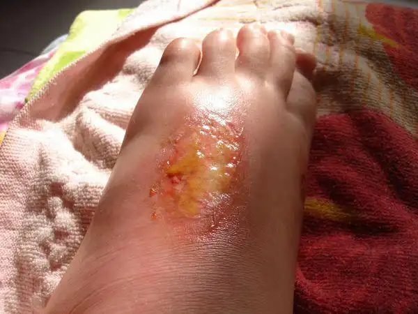 烫伤后用冷水和毛巾敷过,抹过一种绿色的药膏