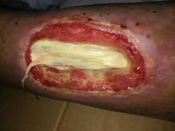 干性坏疽后如何判断肌键是否坏死