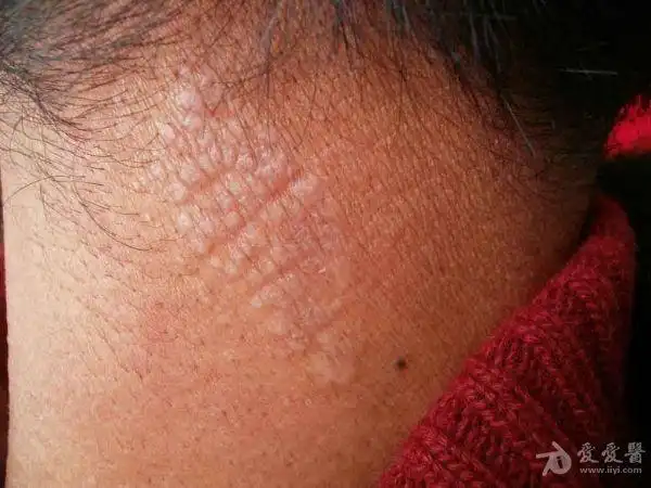 病例分享:神经性皮炎.