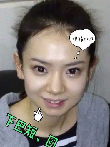 辨识度很高去年戚薇大方承认自己割了双眼皮但是她仅仅只割了双眼皮吗