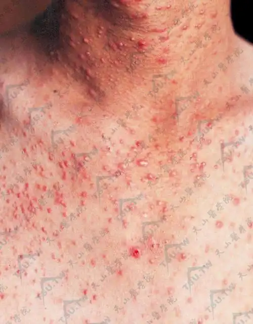 马拉色菌毛囊炎:病因,症状,诊断治疗参考