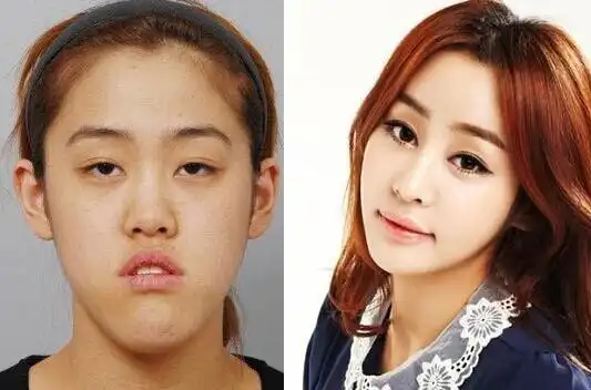 许誉恩整形前后 对比图