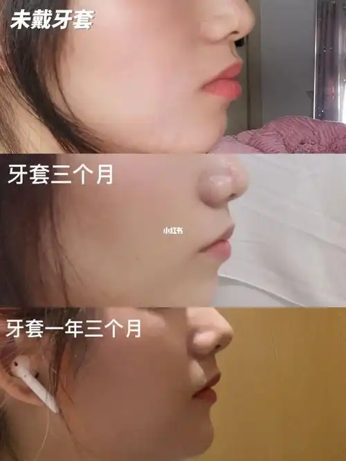 戴牙套一年多的改变