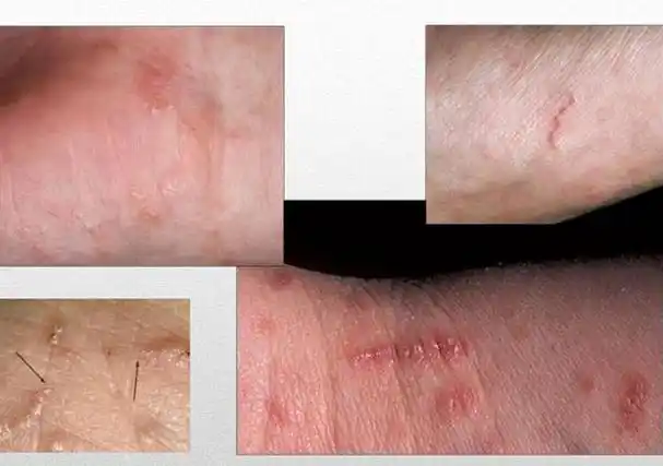 什么是疥疮是什么样子症状图片