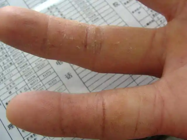 手指干裂,脱屑 - 皮肤及性传播疾病讨论版 - 爱爱医医学论坛