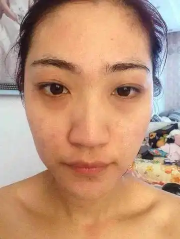 我大概三四年没有吃虫药了,现在皮肤粗糙,而且脸上有痘痘,这两件事有