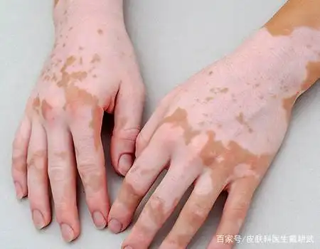 白斑不一定都是白癜风这些皮肤白斑病很容易和白癜风混淆