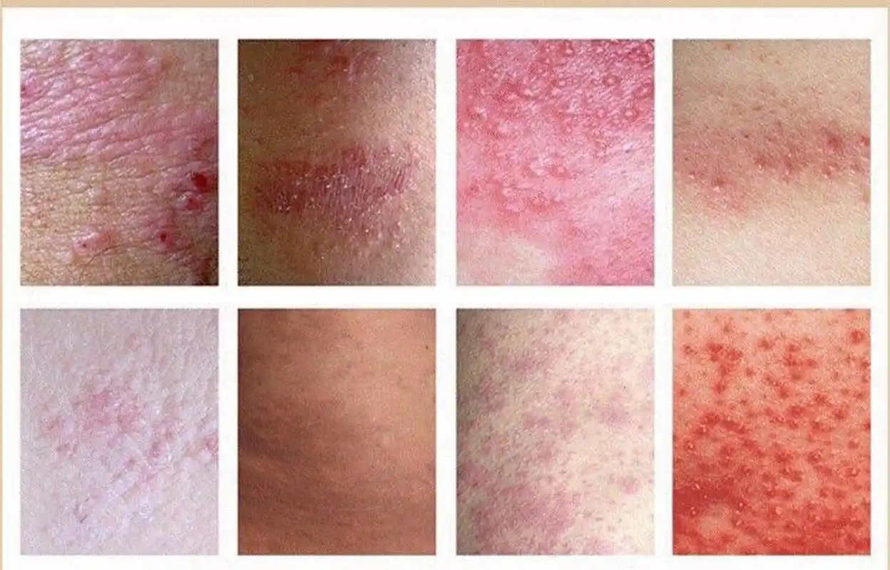 2岁孩子手脚反复出现湿疹样的红疹,反反复复的是怎么回事?