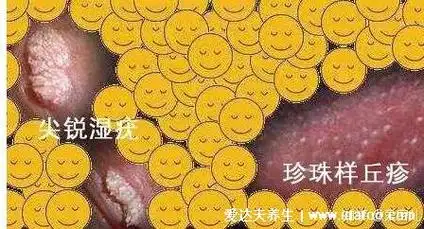 男女性尖疣湿晚期病症图片