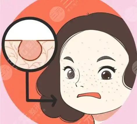 激光治疗毛孔粗大能维持多久不复发?技术原理是什么?术后应该怎么做?