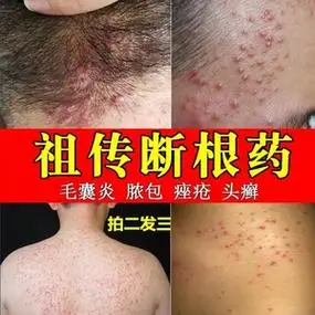 治疗头皮毛囊炎专用药头部后脑勺头癣去根前胸后背银屑癣根治药膏