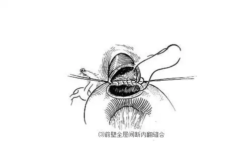 食管空肠端侧吻合术过程手术图解