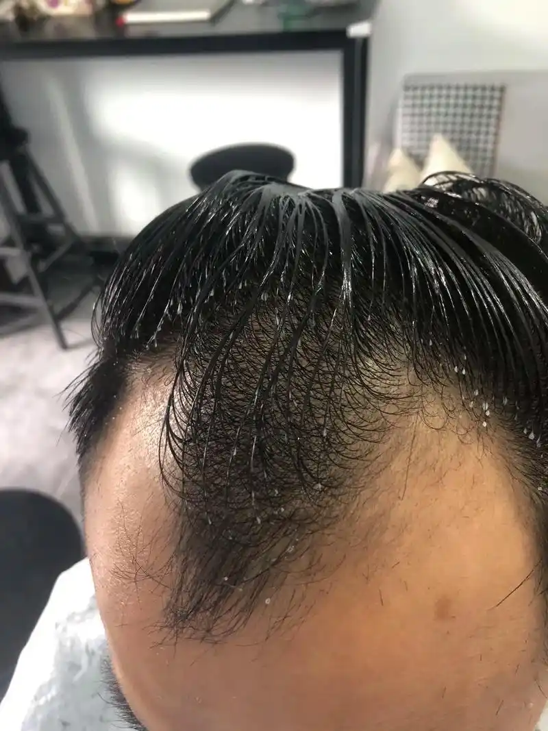 前秃发际线锡纸烫修复遮盖.