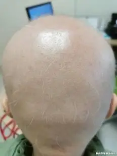 90后女程序员长期熬夜患斑秃头发眉毛全掉光像卤蛋