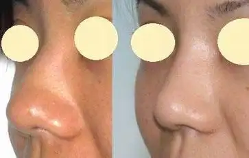 鼻翼缩小有副作用吗