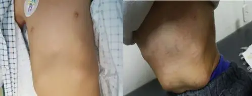 【健康过大年】中心医院铁东院区胸外科为7岁漏斗胸患儿独立完成nuss