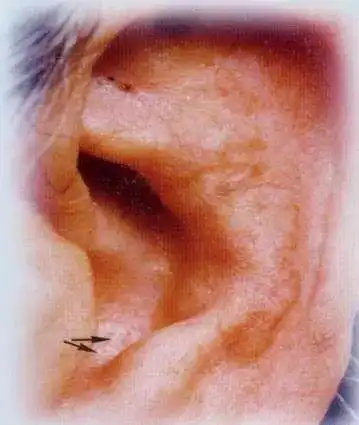 神奇看一下耳朵就能发现肿瘤