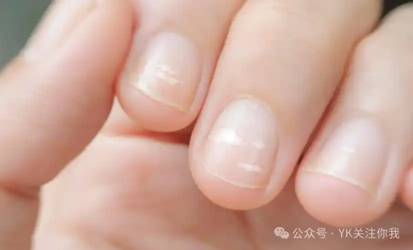 指甲有竖纹白斑是死亡信号出现这几种状况要注意